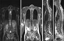 Diagnostic algorithms for axial spondyloarthritis (SpA) in patients
