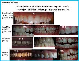 Image result for fluorosis