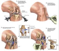 ترمیم منیسک زانو 