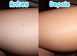 antes e depois