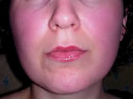 Anyhow this was my face full flush before laser; I have had, i think, 6 treatments now and am pretty much sorted, although in the Spring/Summer it is never ... - ws5hlg