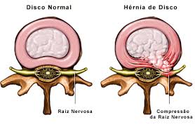 Hérnia de disco lombar (discopatia): hérnia de disco lombar tem cura? Hérnia de disco lombar tem cura? A hérnia de disco lombar nem sempre tem cura porque depende de fatores como grau da lesão, idade e tratamento que o indivíduo pode fazer. Muitas vezes a hérnia de disco não é curada mas os sintomas desaparecem e o indivíduo consegue ter uma vida normal. Dependendo da gravidade da hérnia de disco e da profissão do paciente, em alguns casos ele poderá se aposentar por invalidez.