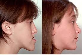 Image result for jaw surgery