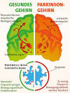 Parkinson (Morbus Parkinson Ursachen)