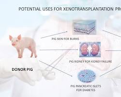 Xenotransplantation