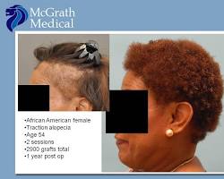 Image of Traction Alopecia hair loss