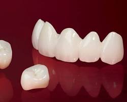 روکش دندان زیرکونیوم