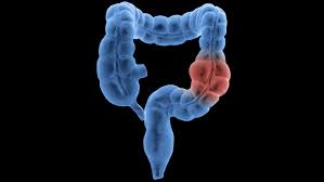 

Rise of Colorectal Cancer in Adults Under 55, Report Reveals