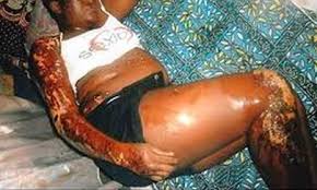 Image result for image Angry Woman Sets Lover Ablaze