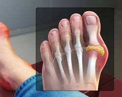 person's swollen and red big toe due to goutの画像