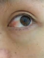 Image result for Hyperaemia