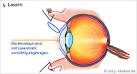 LASIK for Spherical Refractive Myopia: Effect of Topographic