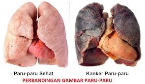 Image result for kanker
