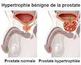 Le traitement de l hypertrophie de la prostate - Urologie Davody