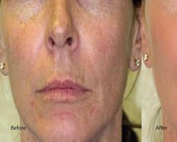 Image of patient with sun damage on the face and neck before a chemical peel