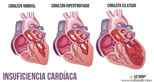 Resultado de imagen de imagenes de insuficiencia cardiaca congestiva