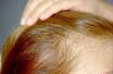 Haarausfall Typen - Ursachen für Haarausfall - Priorin N