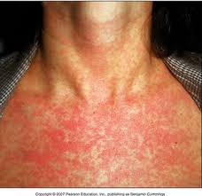Kết quả hình ảnh cho rubella