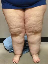 Billedresultat for fat people problems