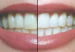 diş beyazlatma ile ilgili görsel sonucu
