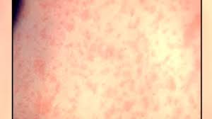 Measles Exposure Alert: Amtrak Passenger Travels from NY to DC While Contagious