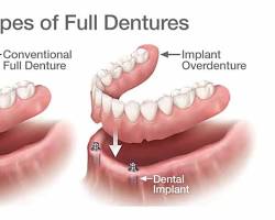 Conventional dentures