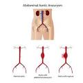 Aortenaneurysma - Ursachen und Behandlung