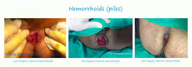 Image result for hemorrhoids