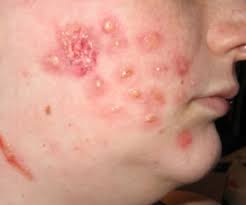 Image result for carbuncle