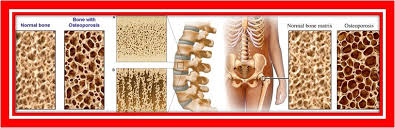 Image result for ‫پوکی استخوان (۱)‬‎
