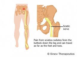 Sciatica: Low back and Leg Pain Diagnosis and Treatment Options Images?q=tbn:ANd9GcT9aoQY60gz1AdC0SqpvZvnhfNyt8MRAl-hNgIfhElW1HBpm2GJjA