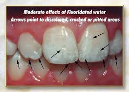Image result for fluorosis