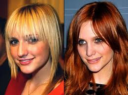 Resultado de imagem para before after surgery