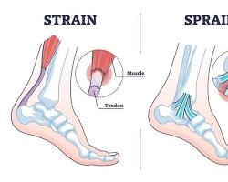 Image of Strains in foot