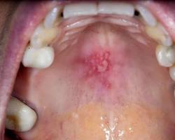 Image of Cold sore on the roof of the mouth