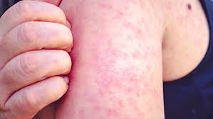 Measles Alert! Potential Exposure at NY Hospitals - Act Fast!