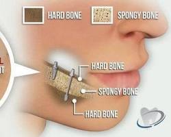 Image of CorticoBasal Implant Procedure Steps