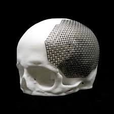 AnatomicsTitanium™ Cranial Implant Manufactured from ...