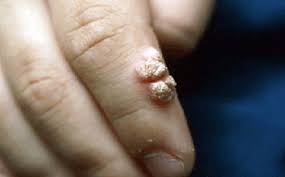 Image result for human papilloma virus
