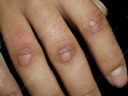 Knuckle pads - Stock Image - C060/7990 - Science Photo ...