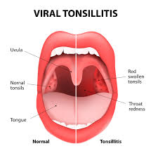 Image result for tonsil stones