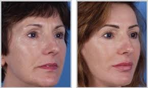 The Derma Laser Peel&#39;s laser beam is scanned over a treatment area to precisely ablate (vaporize) a very thin layer of skin, removing old, damaged tissue. - resurface-before-after-01-300x180