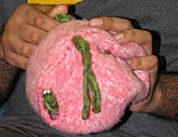 Image result for teratoma