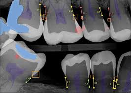 Enhancing Patient Care: Students Develop Advanced Dental AI Skills - 1