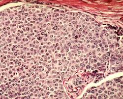 Imagen de Cancer Cell under Microscope