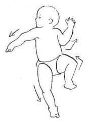 Image result for extensor thrust primitive reflex