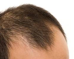 Image of Androgenetic Alopecia hair loss