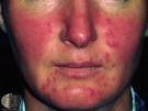 Rosacea