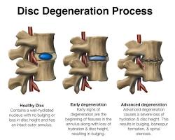 Image of Intervertebral disc degeneration diagram