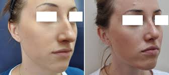 Image result for nose surgery